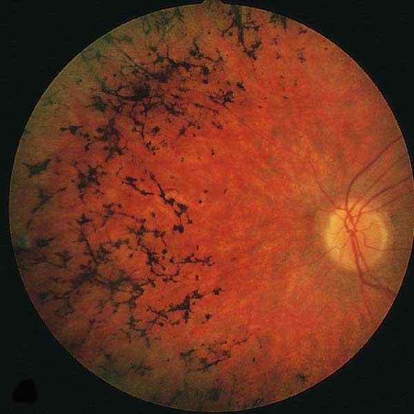 retinose
